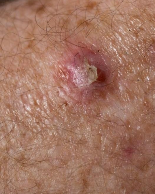 Squamous Cell Carcinoma (SCC) - Unknown