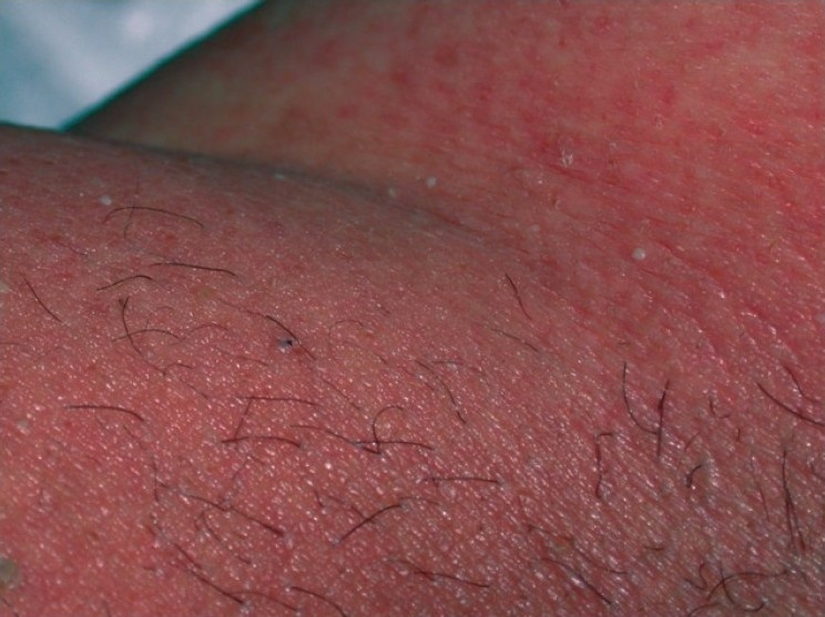 AGEP (Acute Generalized Exanthematous Pustulosis) - Pubic Region