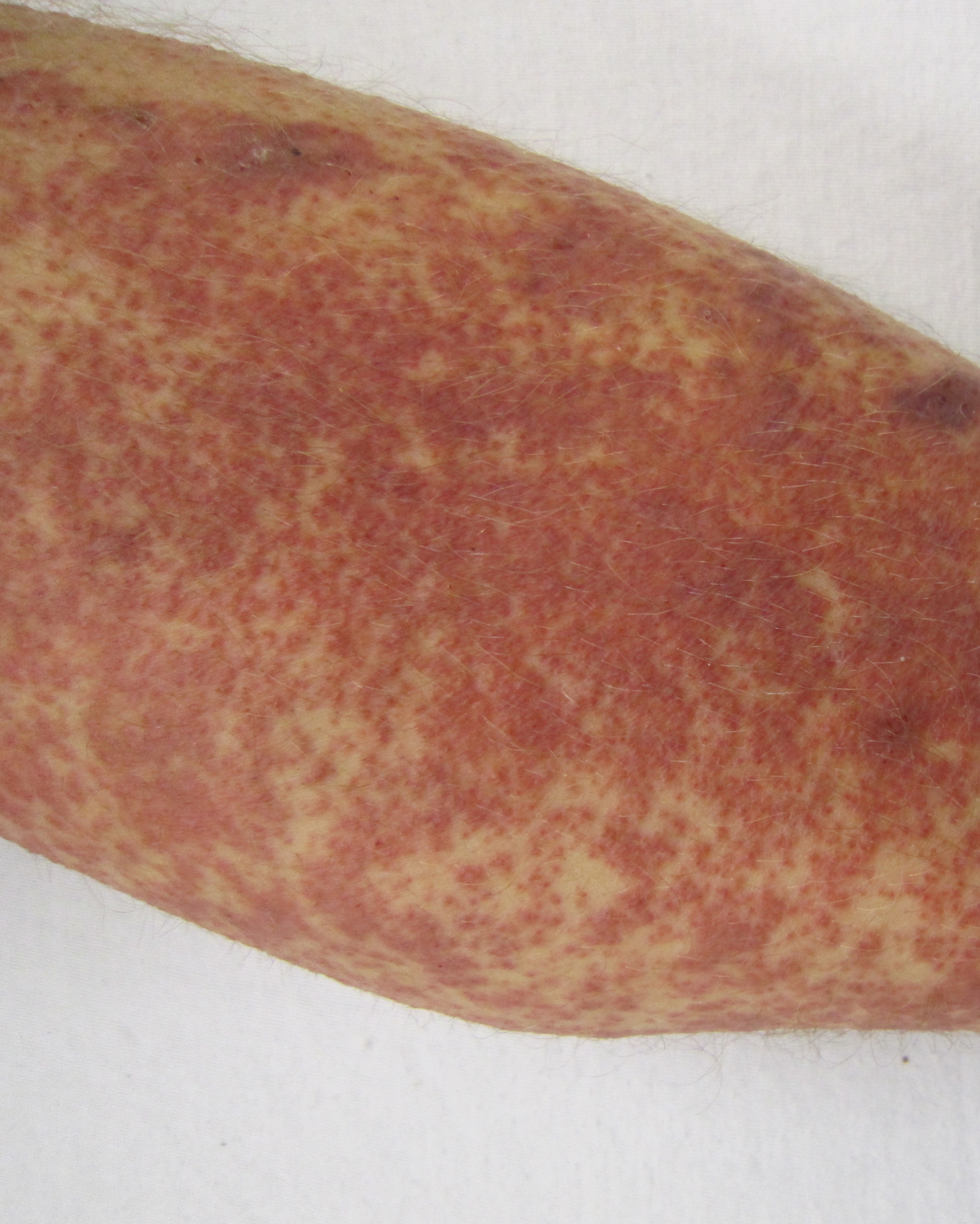 Cutaneous Small Vessel Vasculitis (Leukocytoclastic Vasculitis) - Leg