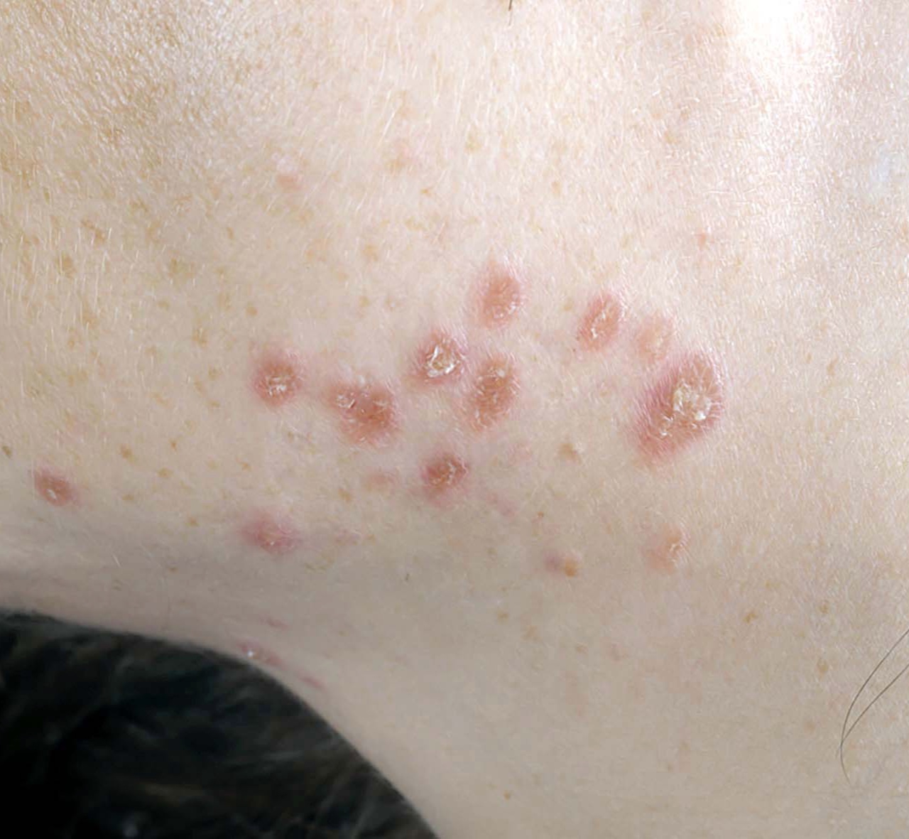 Cutaneous Sarcoidosis - Cheek