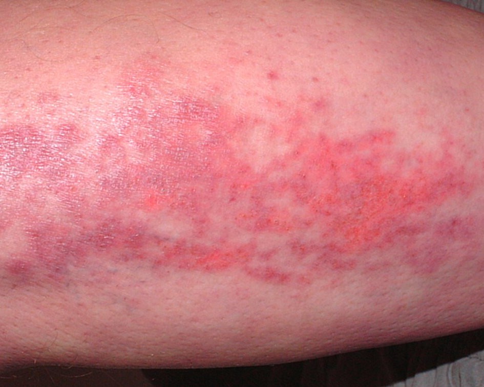 Dermatomyositis - Leg