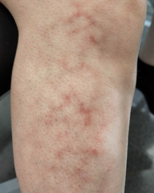 Erythema ab igne - Leg