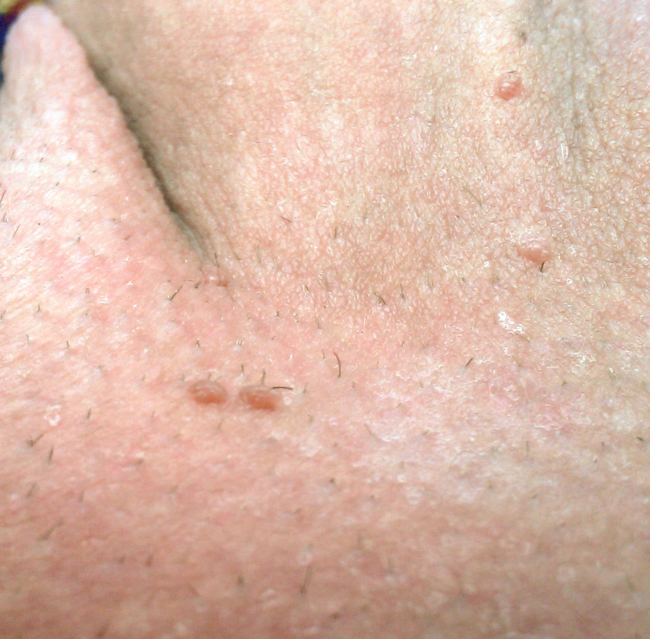 Genital Warts (Condyloma Acuminatum) - Pubic