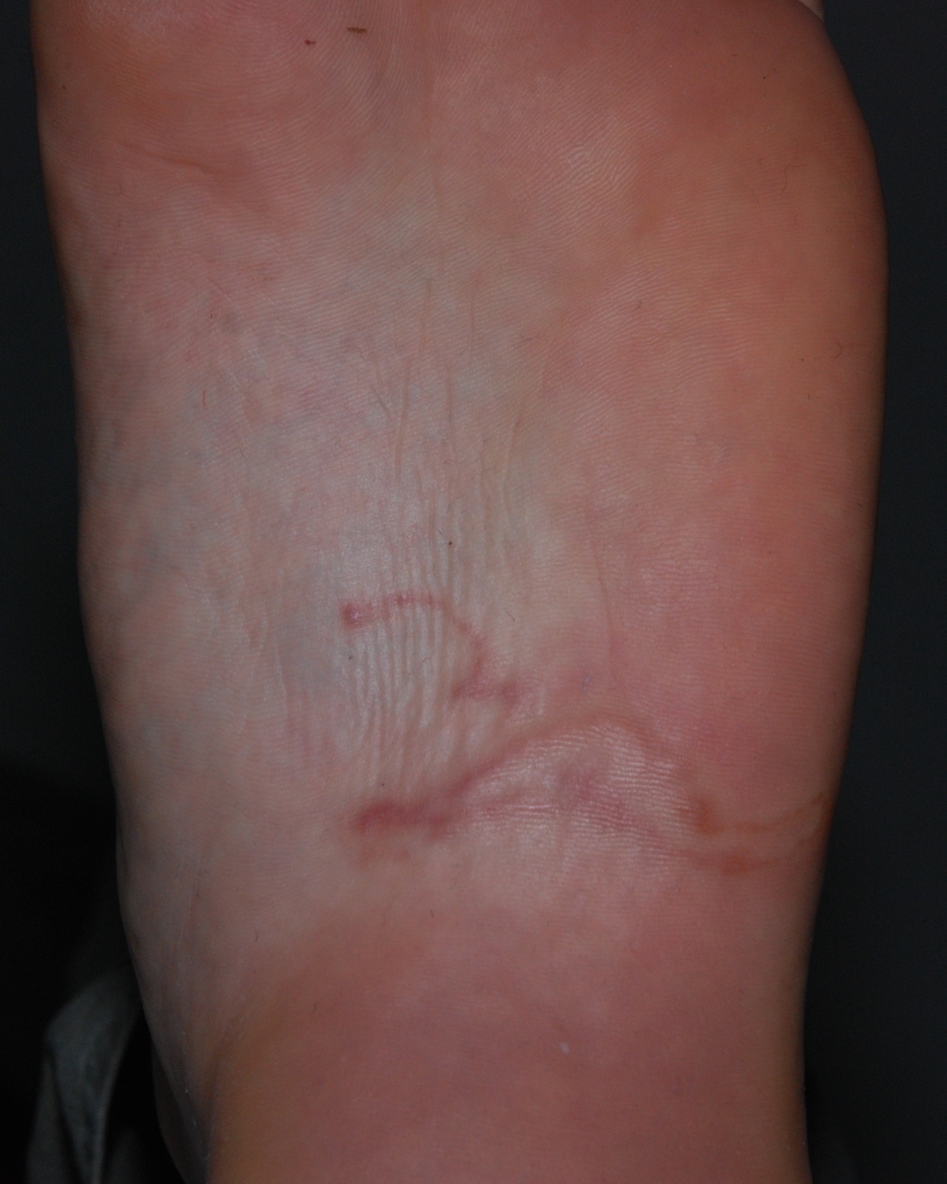 Cutaneous Larva Migrans - Foot