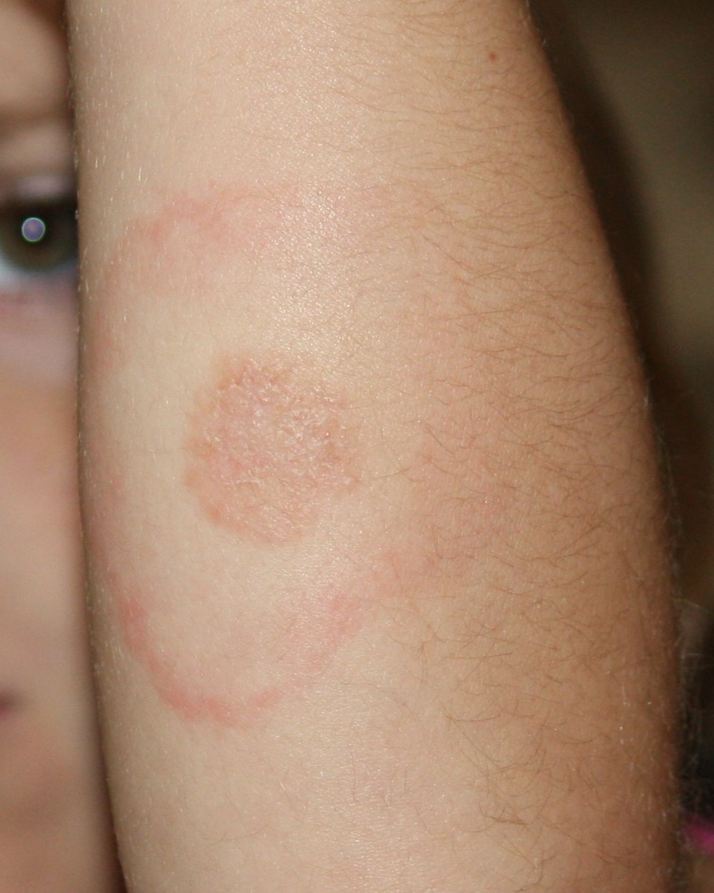 Erythema Migrans (Lyme Disease) - Arm