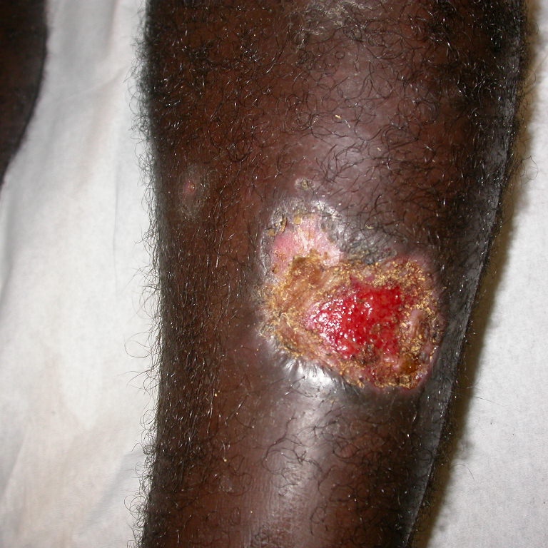 Cutaneous Leishmaniasis - Leg