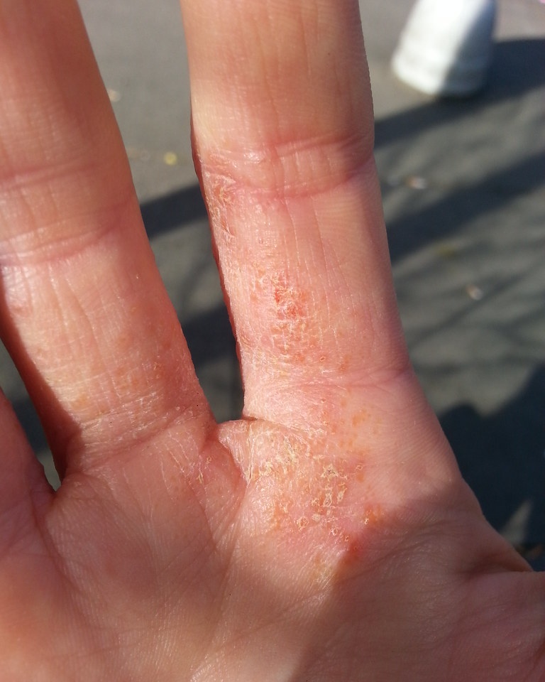 Dyshidrotic Eczema (Pompholyx) - Hand