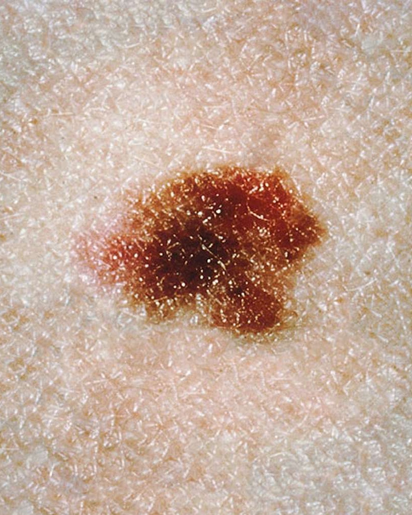 Dysplastic Nevus (Atypical Mole) - Not specified