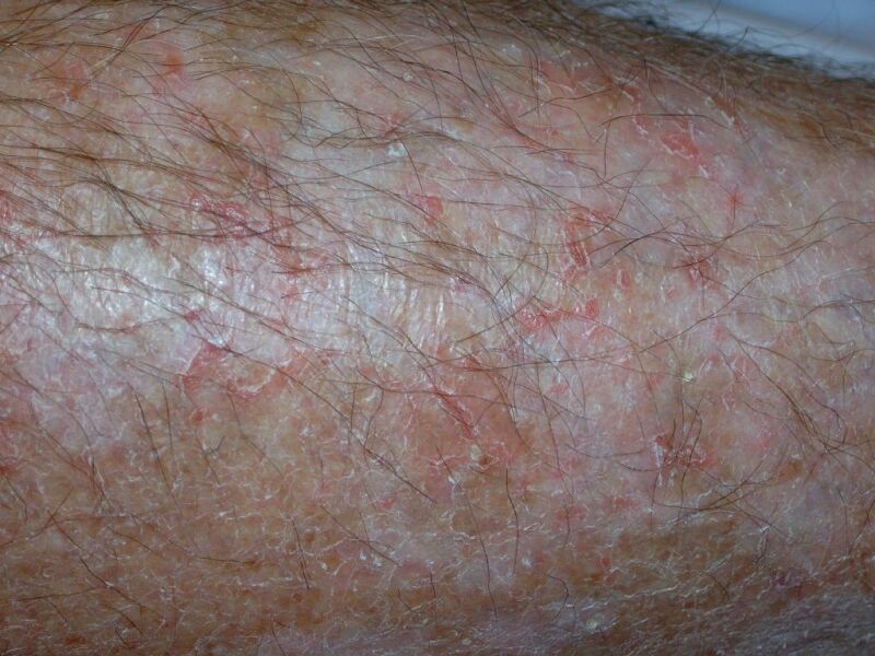 Asteatotic Eczema (Eczema Craquelé) - Clinical image