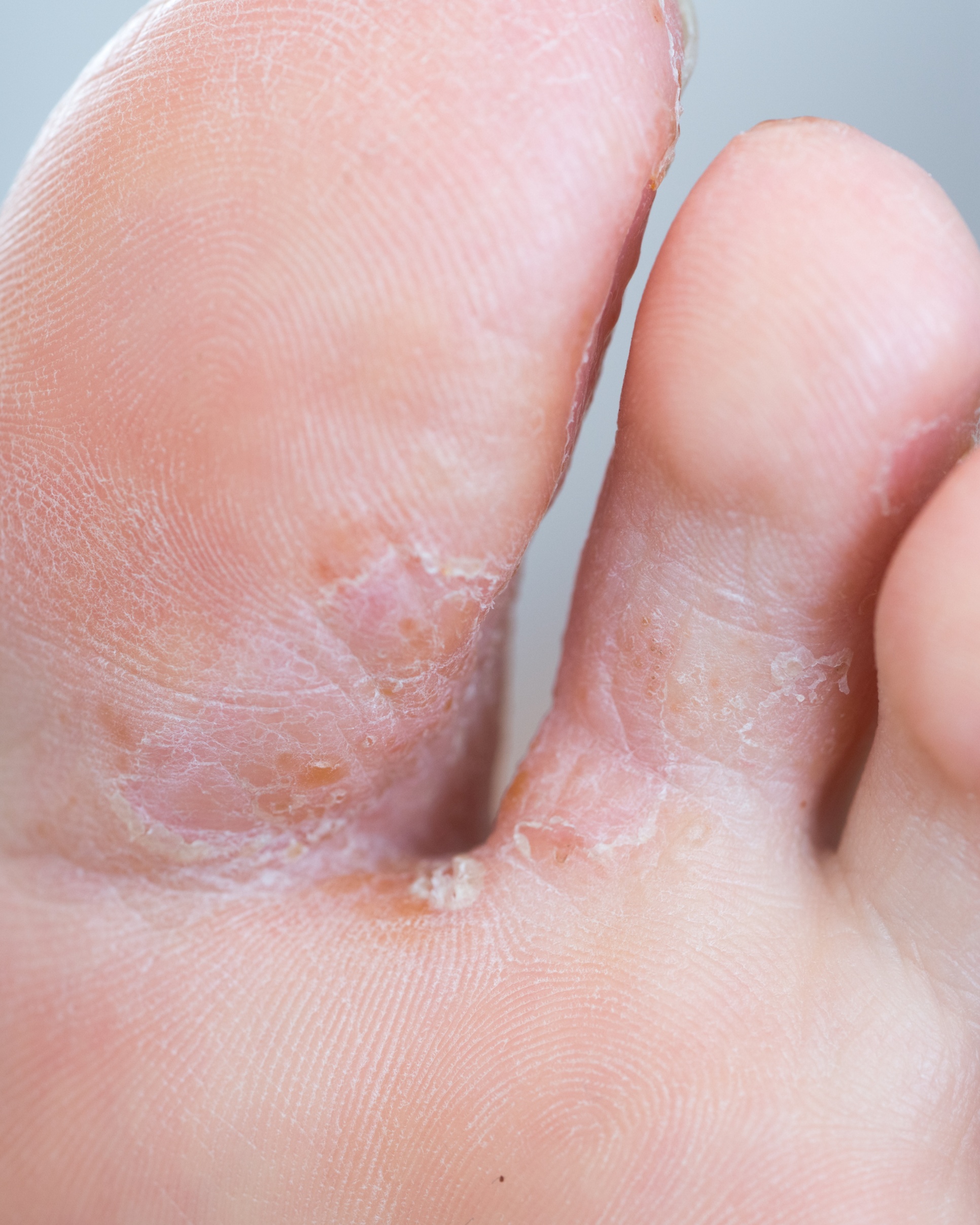 Tinea Pedis (Athlete's Foot) - Foot