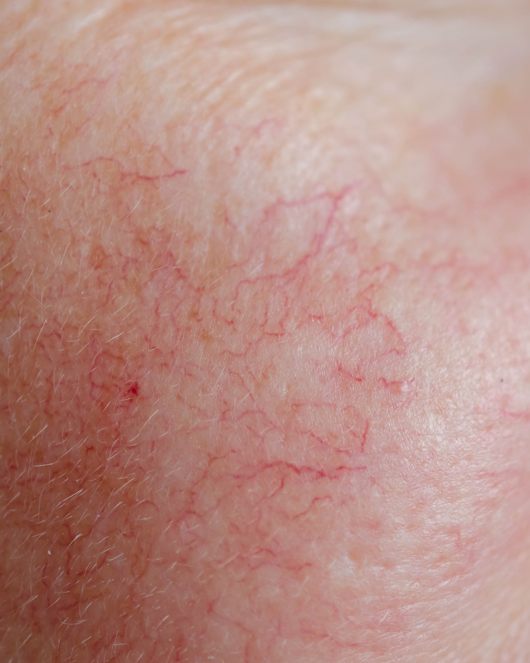 Telangiectasias (Unspecified) - Face