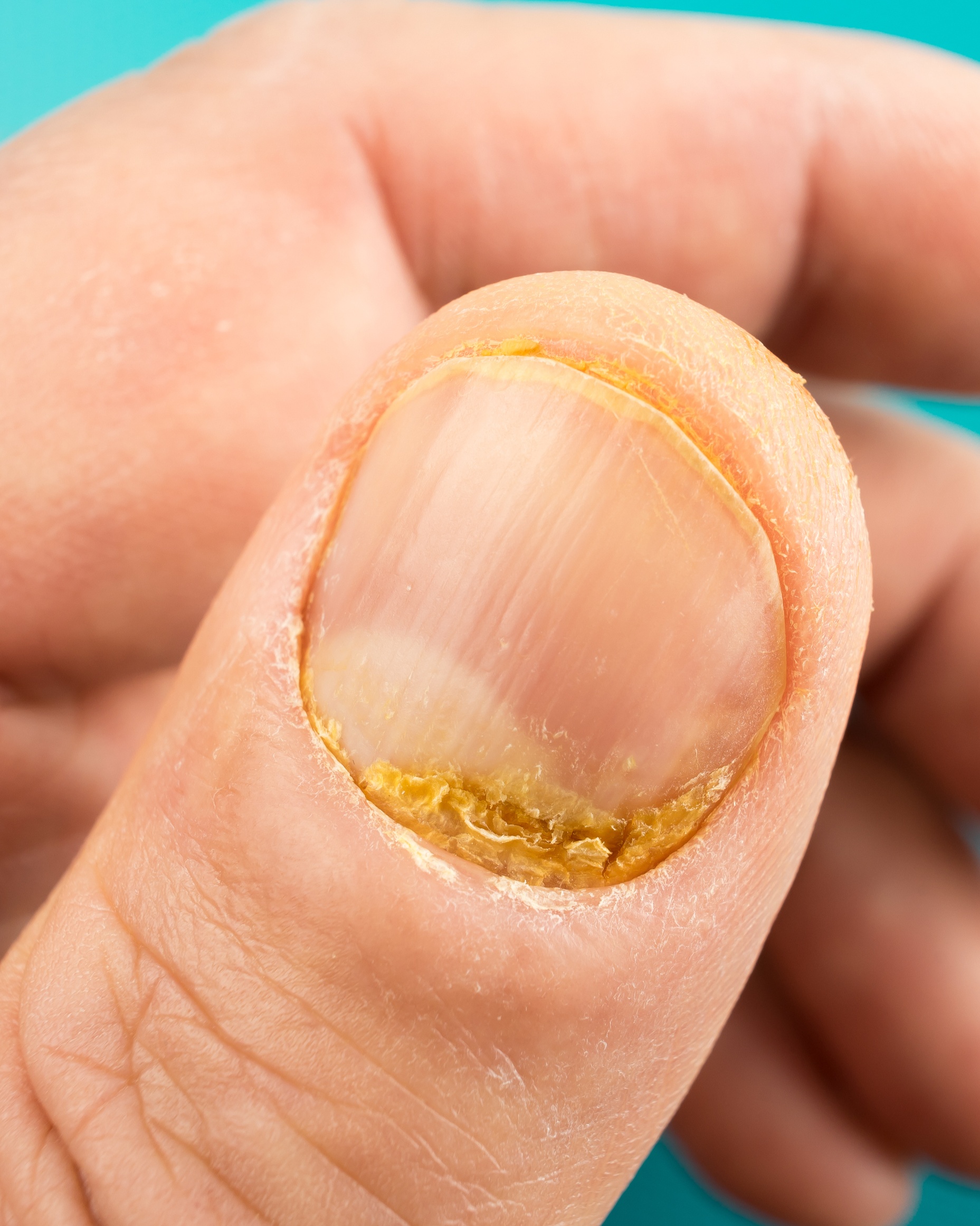 Nail Psoriasis - Thumb