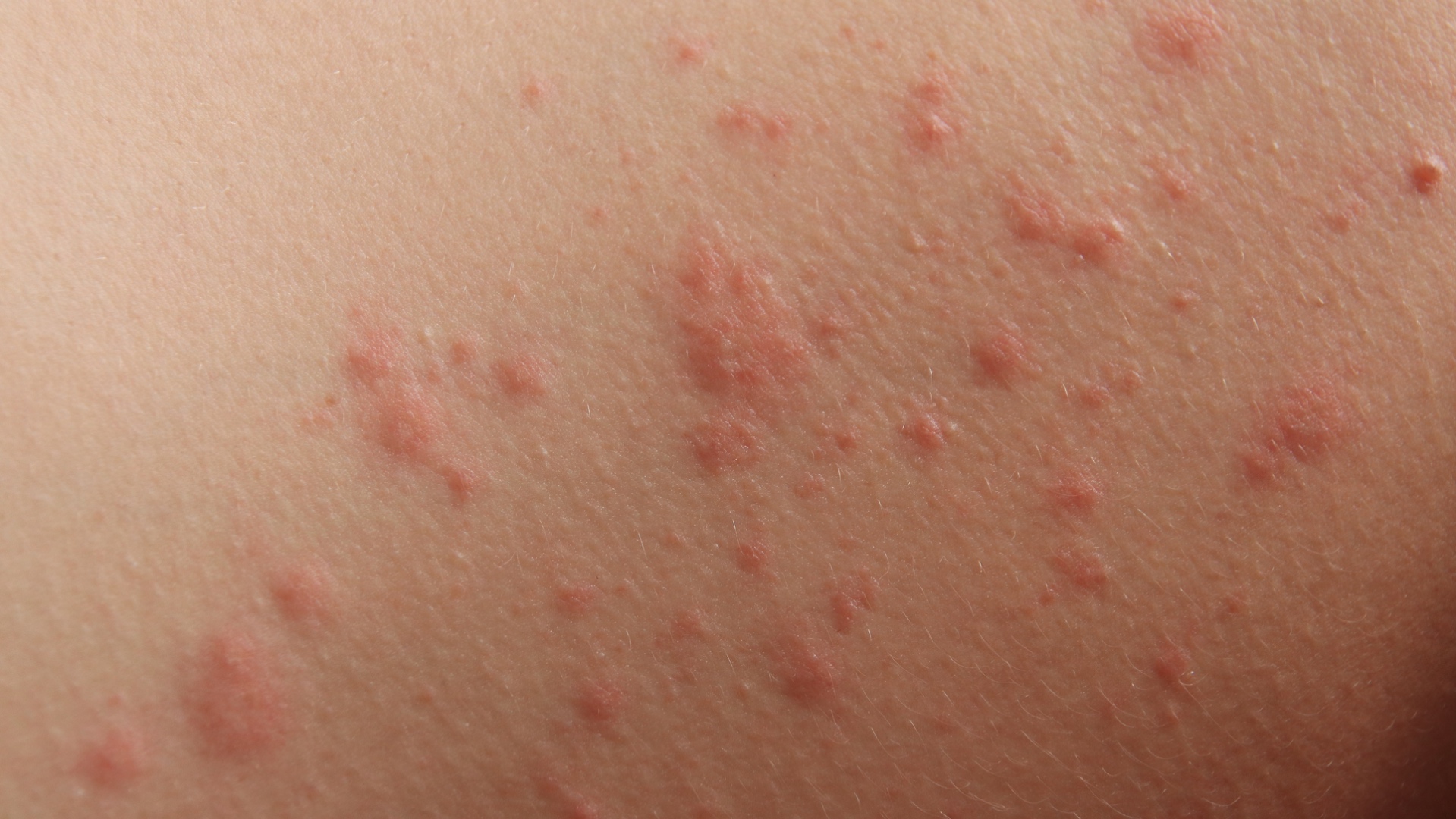 Allergic Contact Dermatitis - Unknown