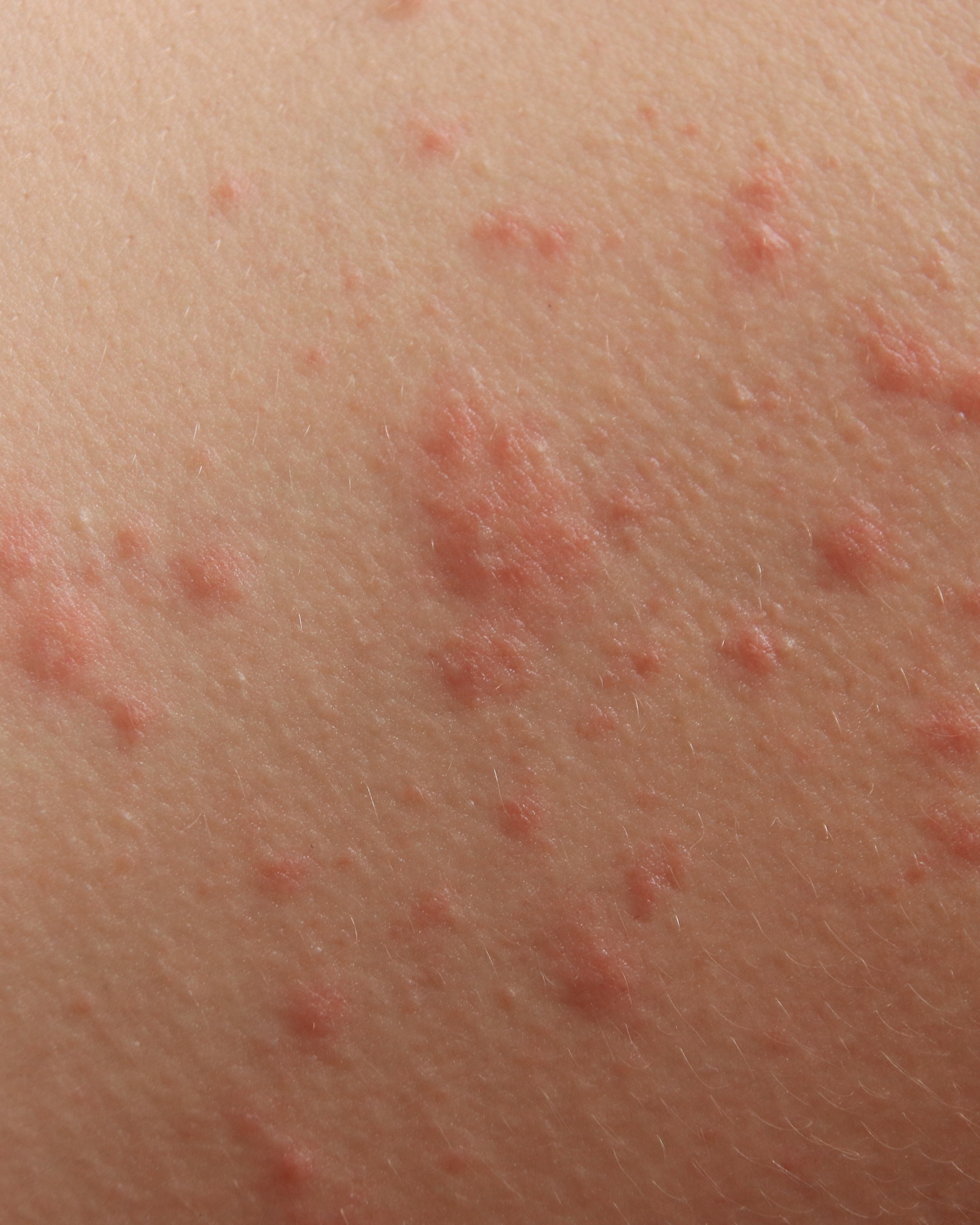 Unspecified Contact Dermatitis - Not Specified