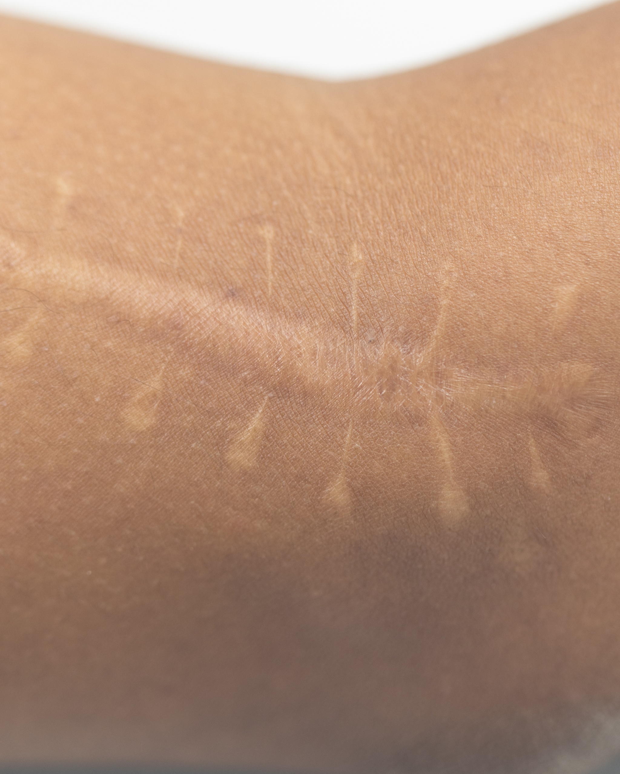 Atrophic Scar - Arm