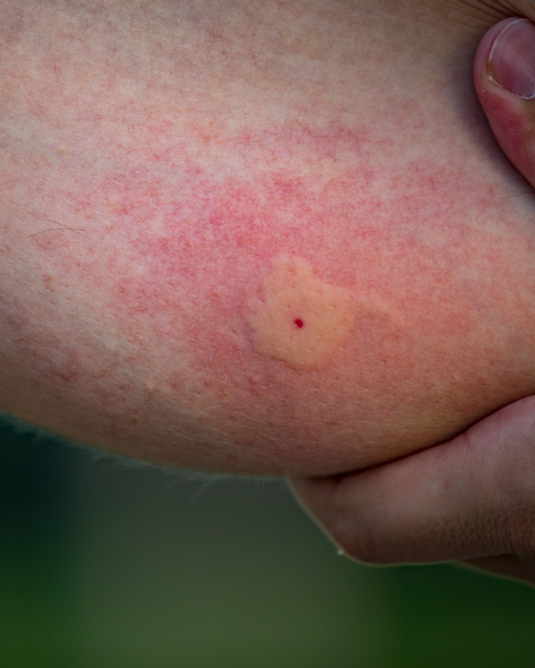 Insect Bite Reaction (Unspecified) - Arm
