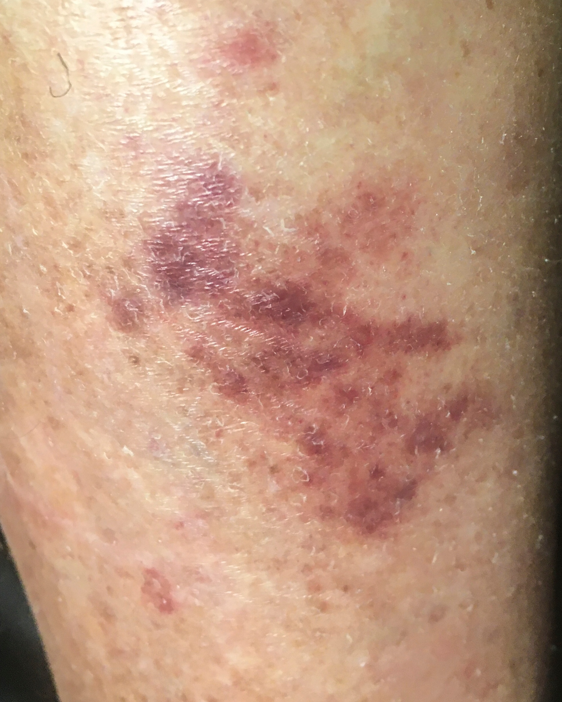 Cellulitis - Leg
