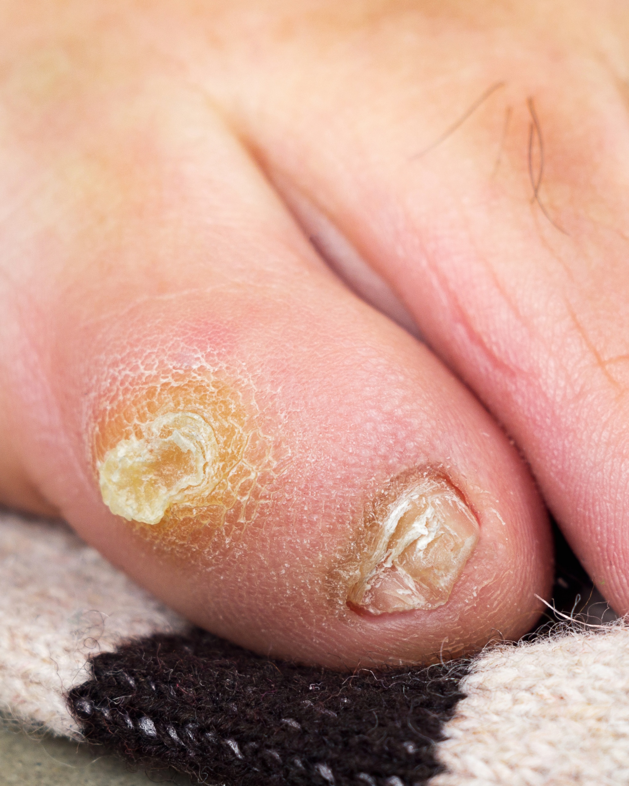 Corn (Clavus) / Callus (Tyloma) - Toe