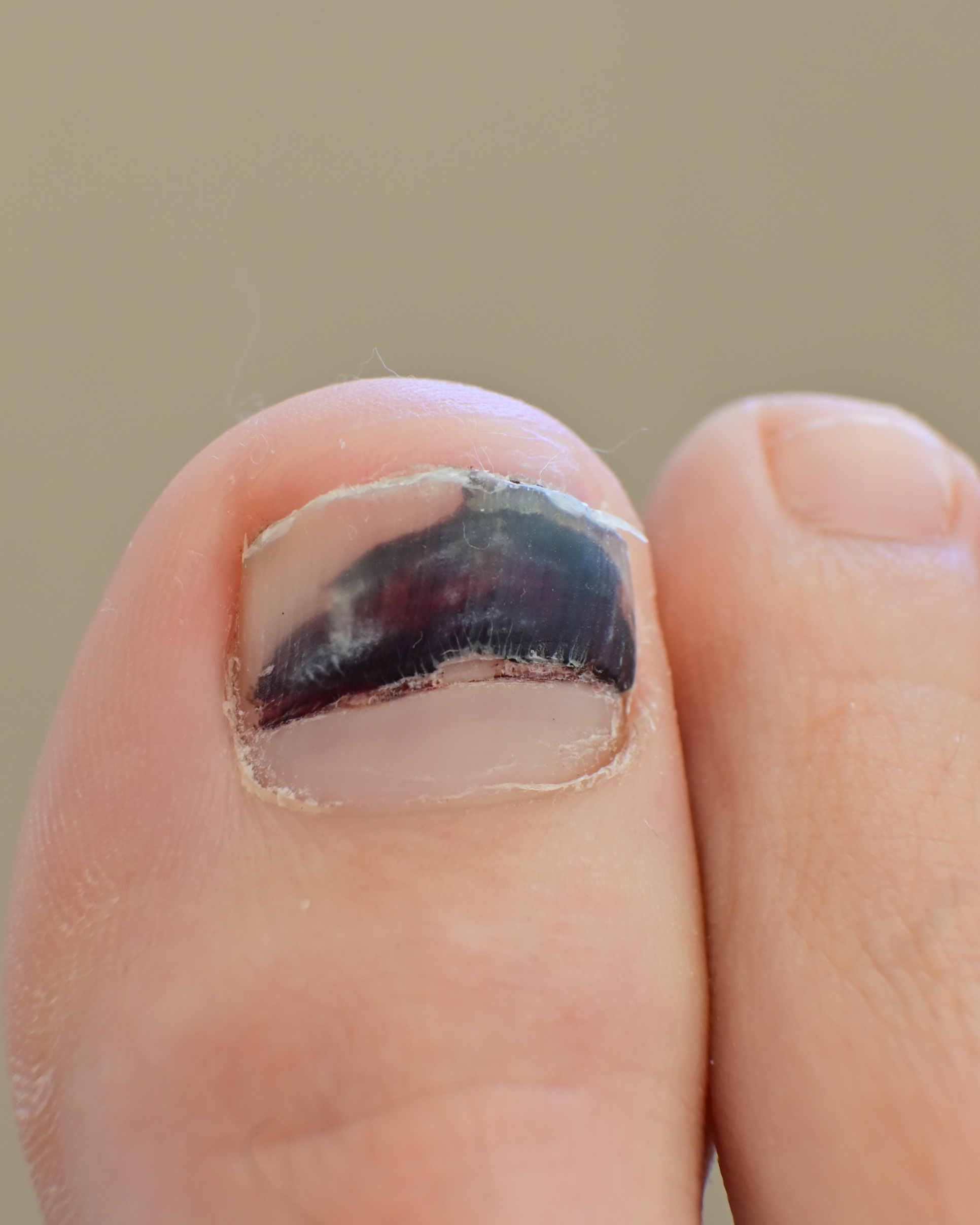 Subungual Hematoma - Toe