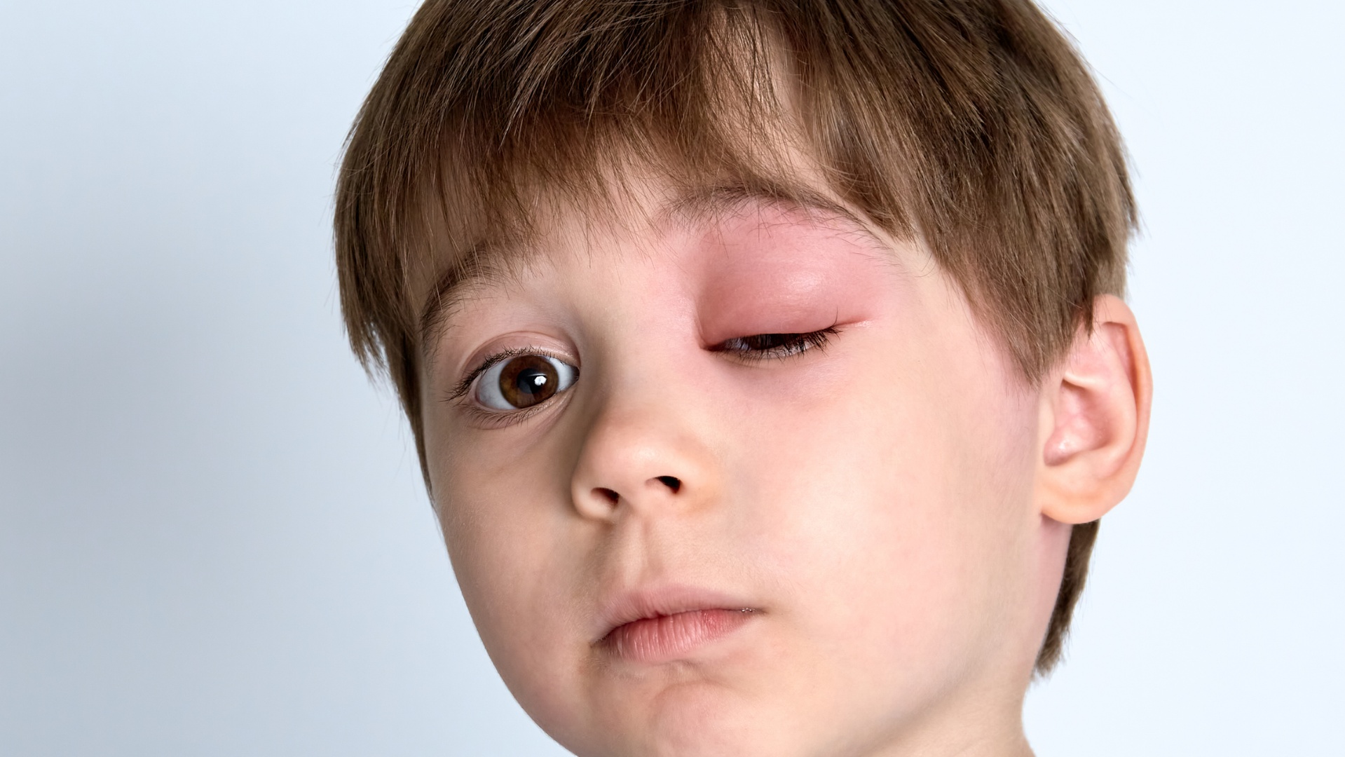 Angioedema - Face