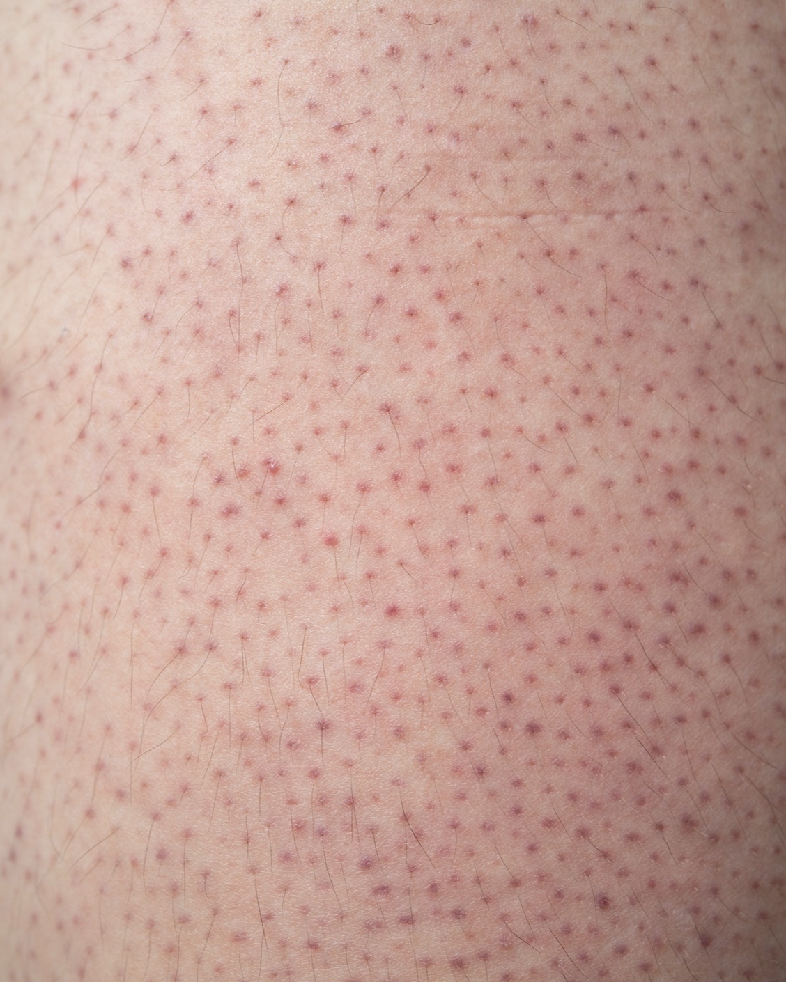Keratosis Pilaris - Not Specified