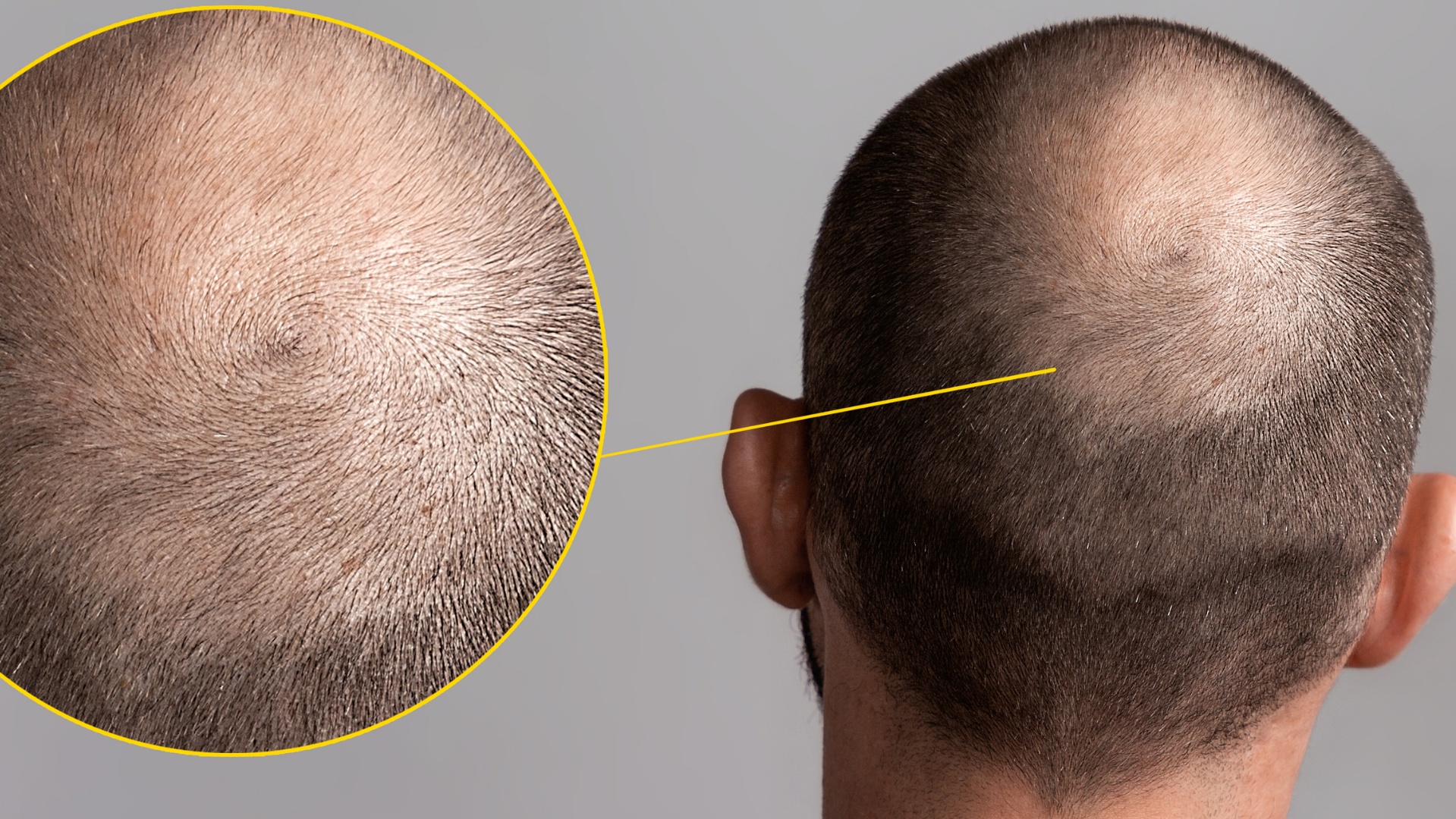 Androgenetic Alopecia - Head