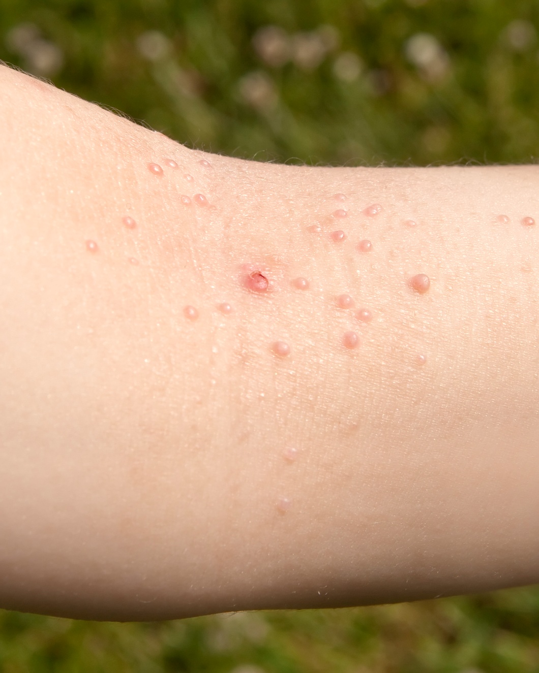 Molluscum Contagiosum - Elbow