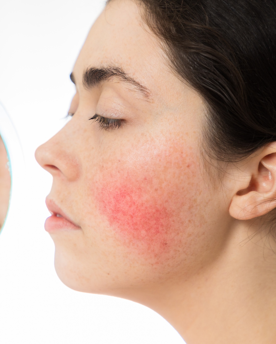 Rosacea - Face