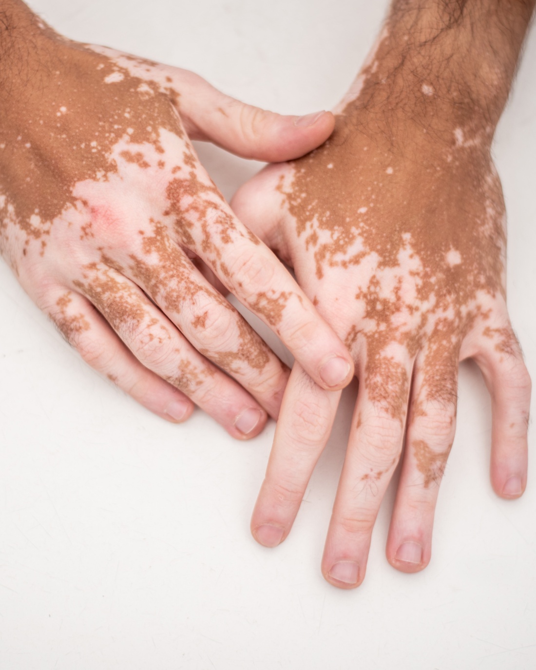 Vitiligo - Hands