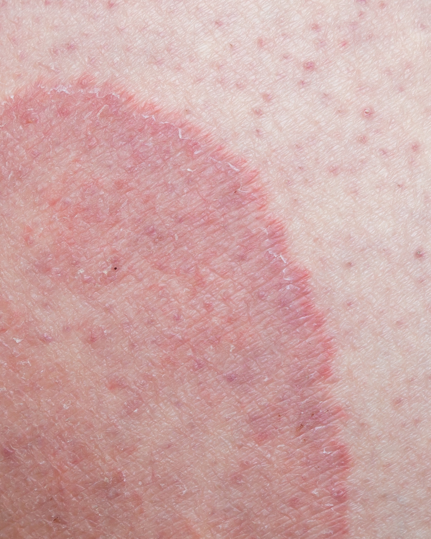 Tinea Cruris (Jock Itch) - Groin