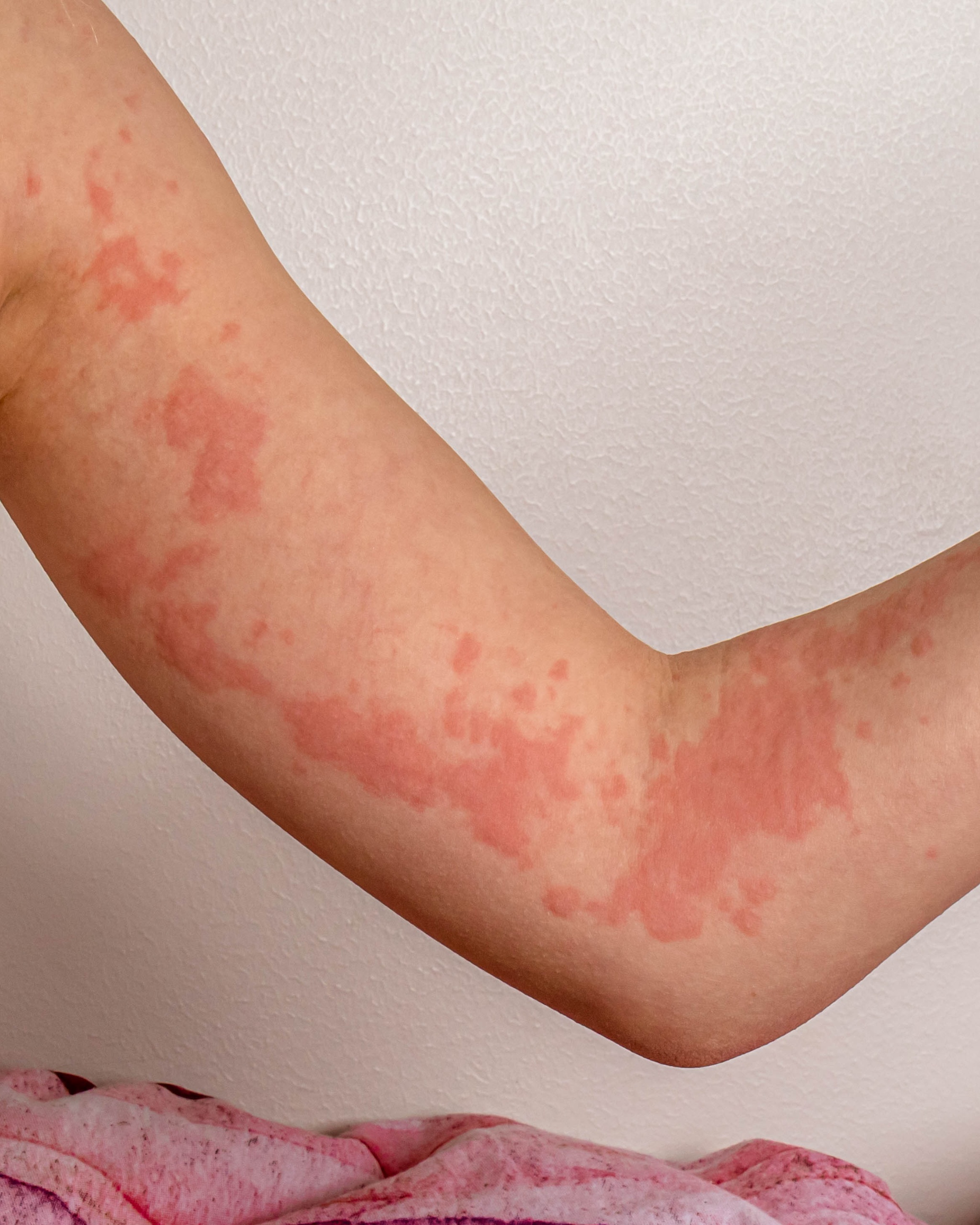 Urticaria (Hives) — Arm