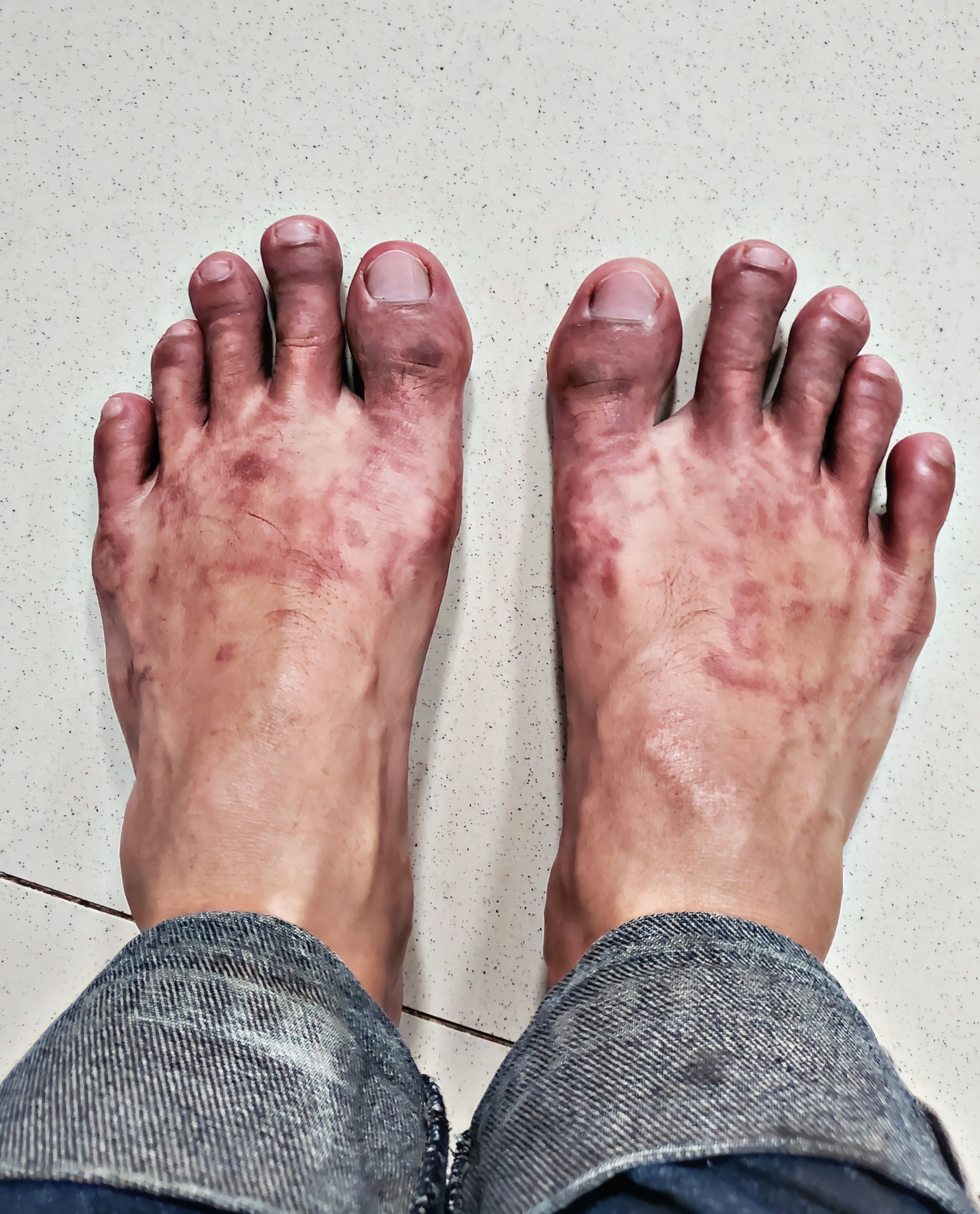 Frostbite - Feet