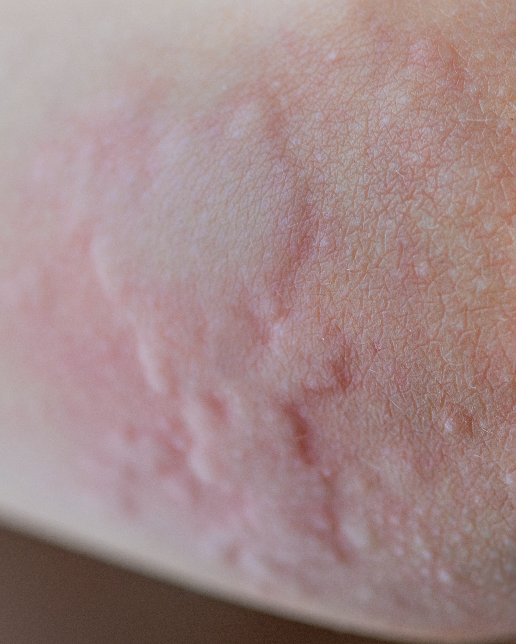 Urticaria (Hives) - Not Specified