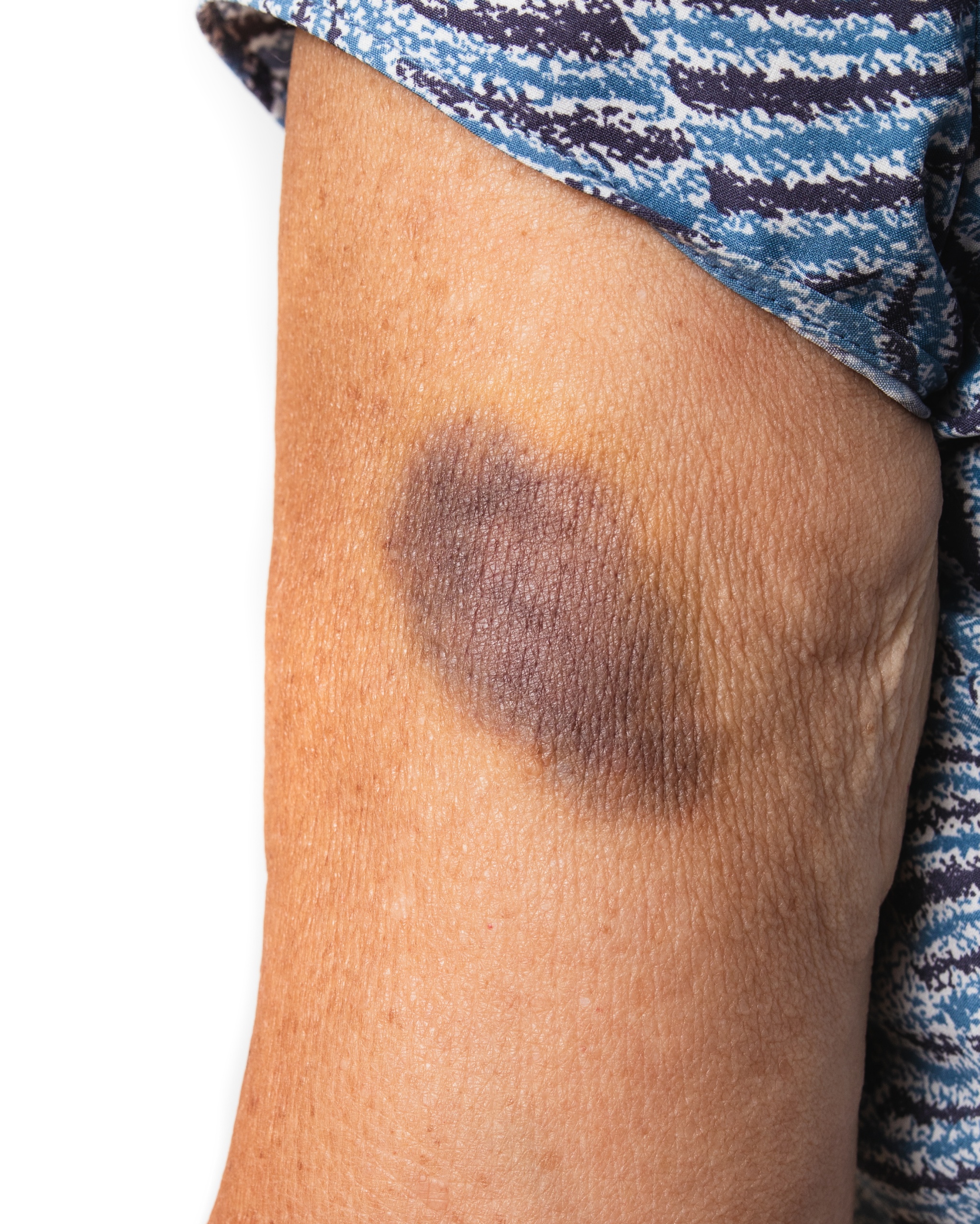 Ecchymosis (Bruise) - Arm