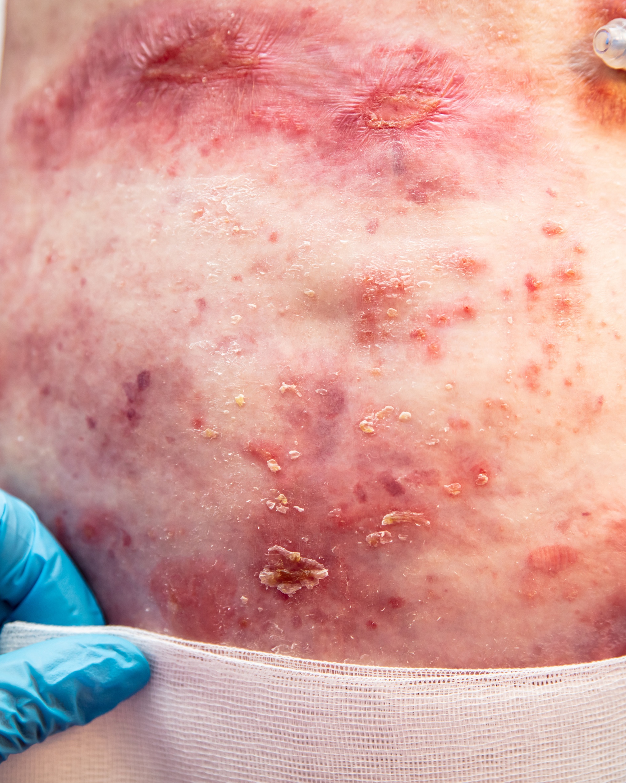 Epidermolysis Bullosa - Torso
