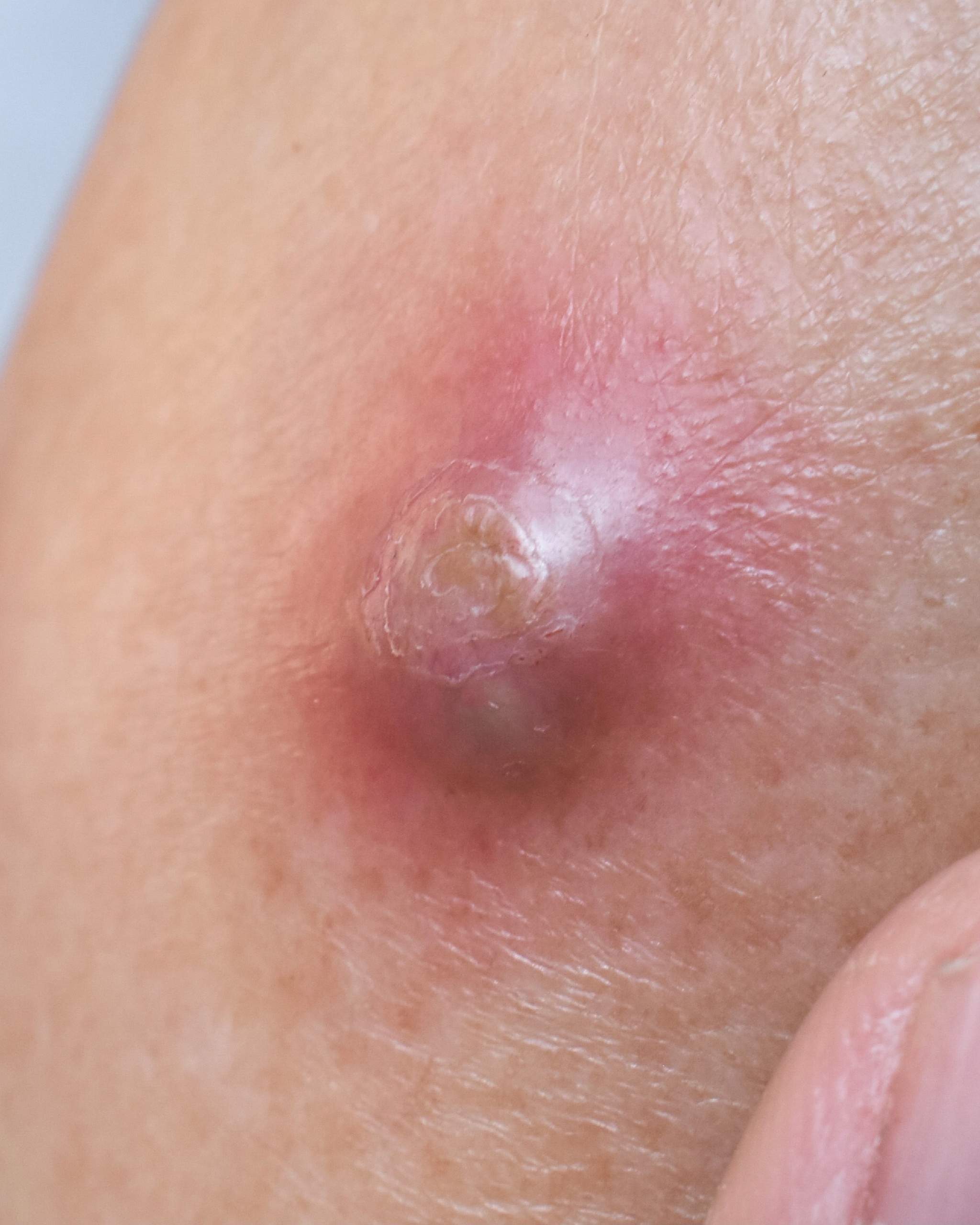 Carbuncle - Clinical image