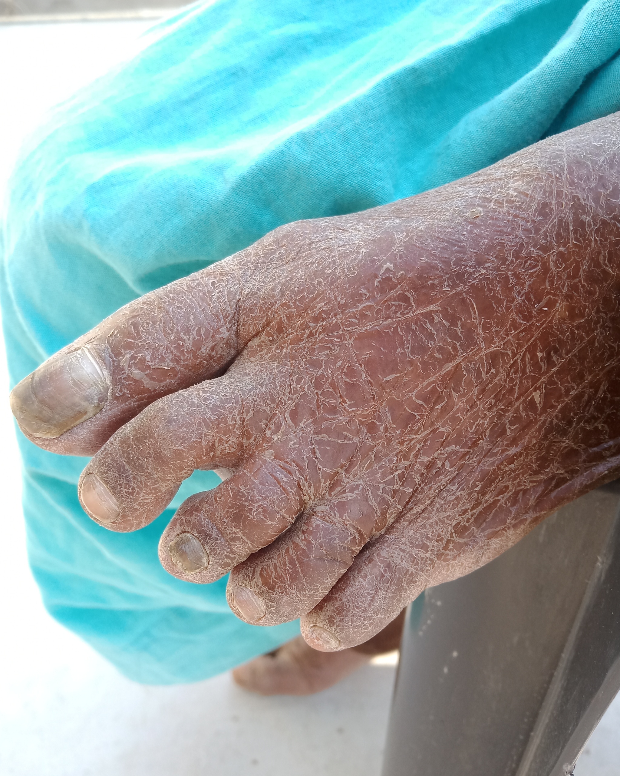 Ichthyosis Vulgaris - Foot