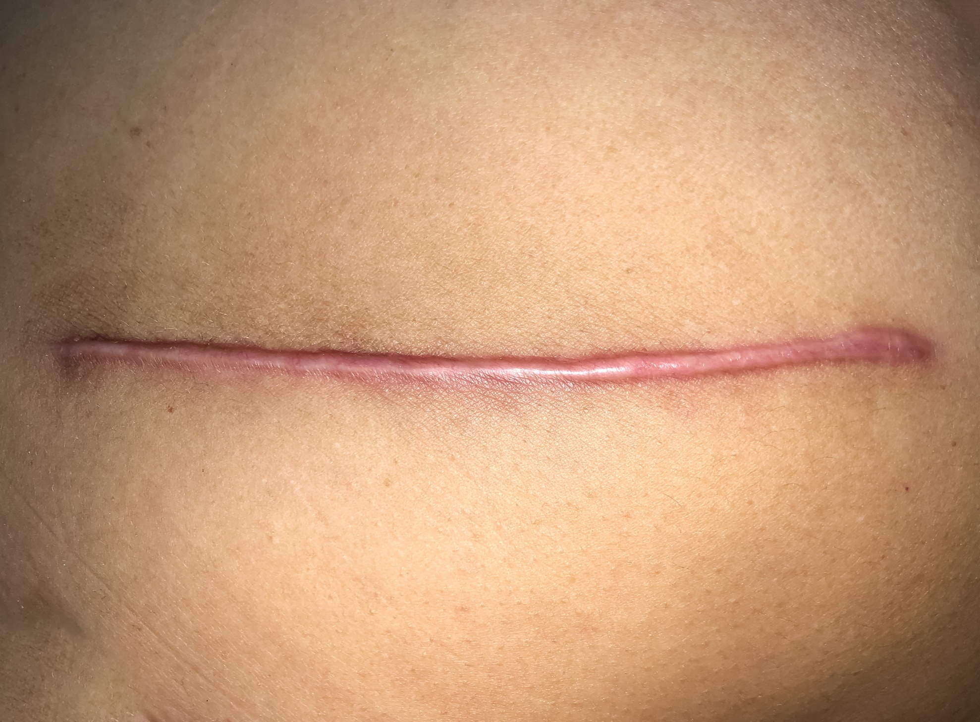 Hypertrophic Scar - Not Specified