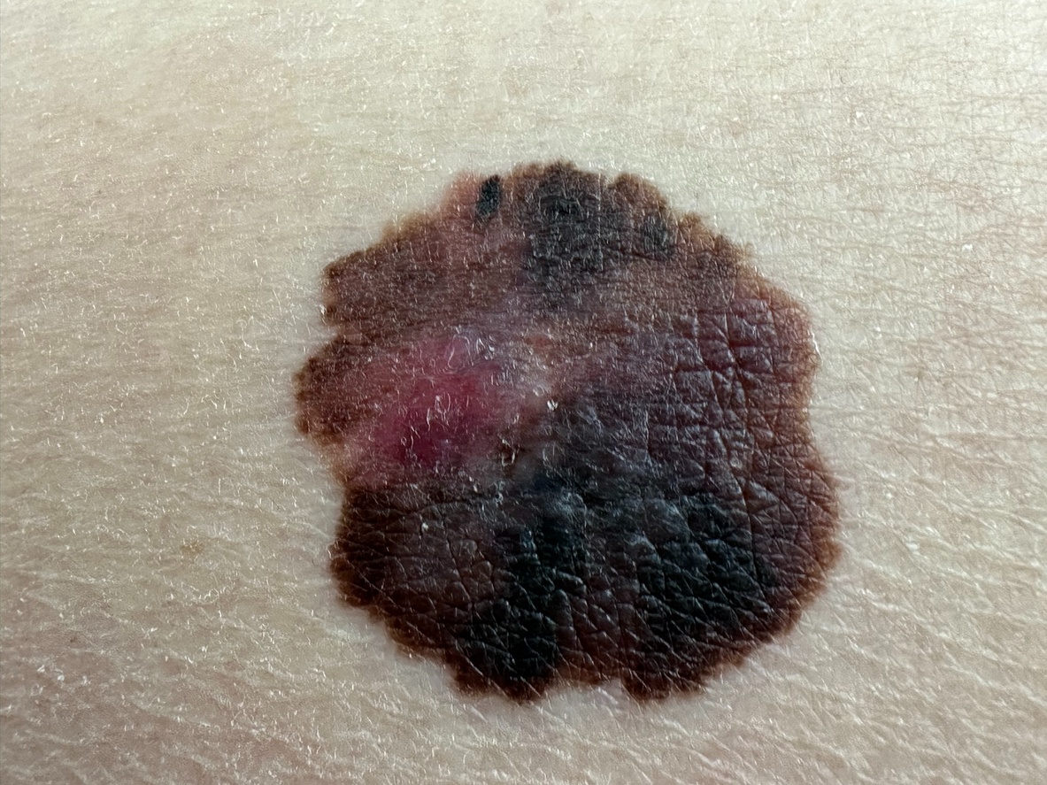 Melanoma - Not Specified