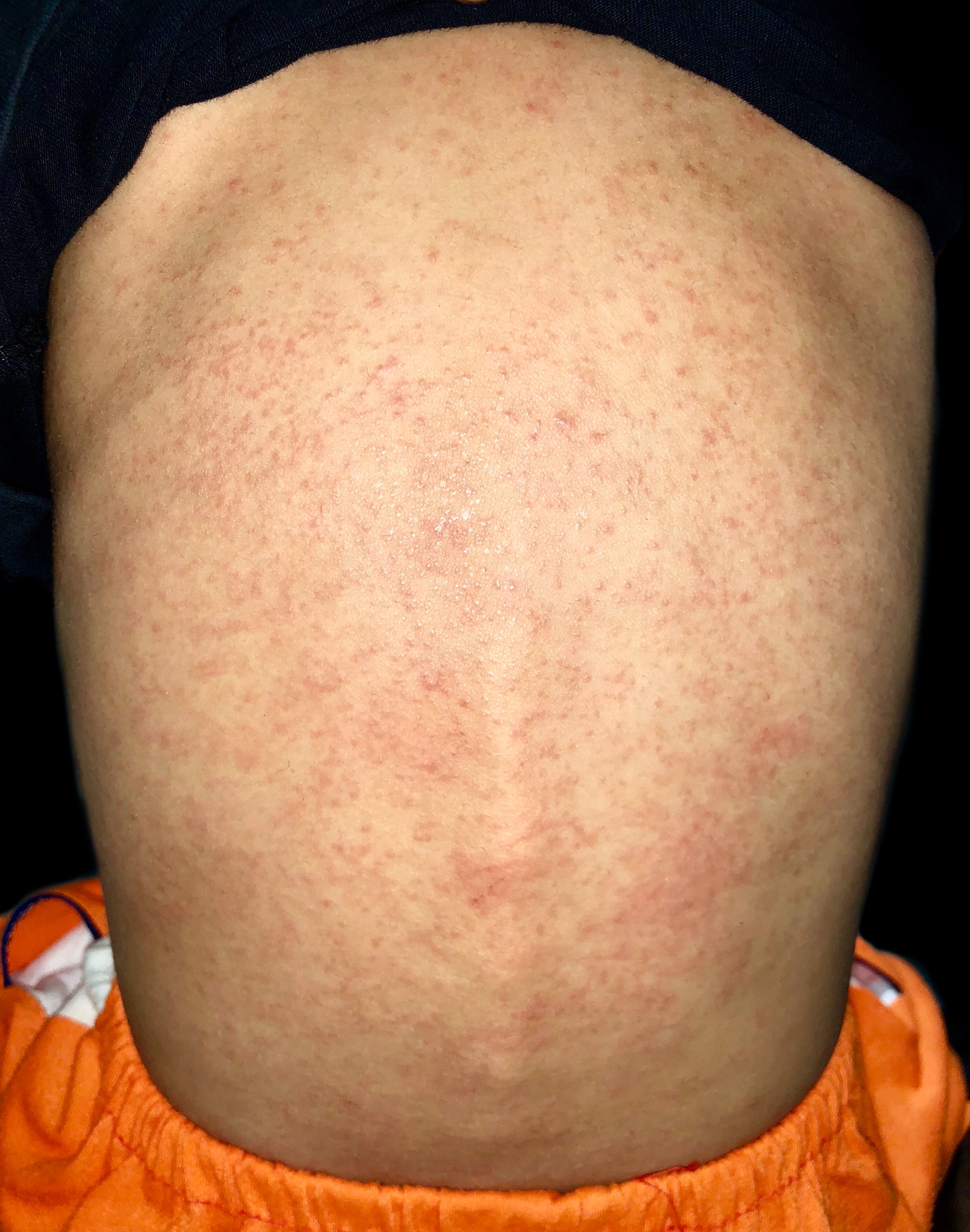 Miliaria (Heat Rash) - Back