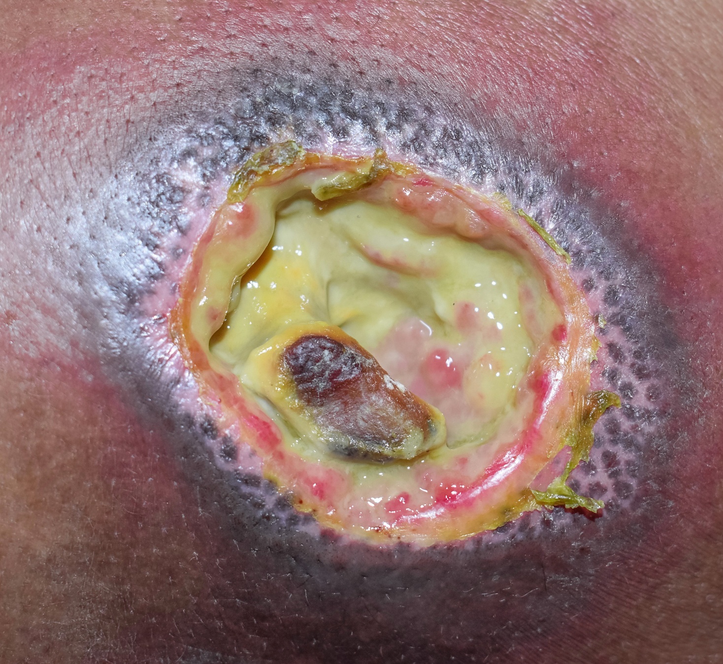 Pressure Ulcer - Not Specified