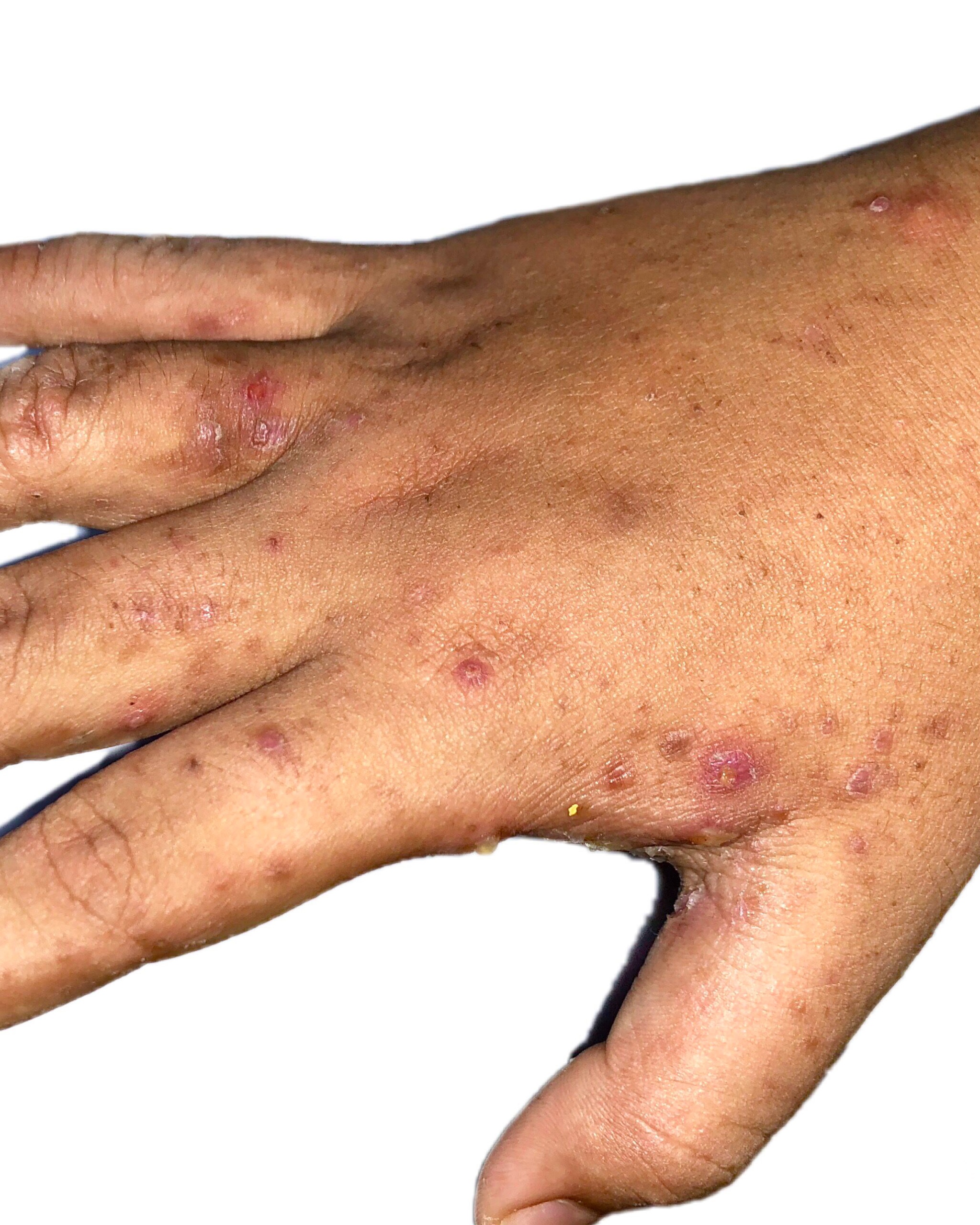 Scabies - Hand