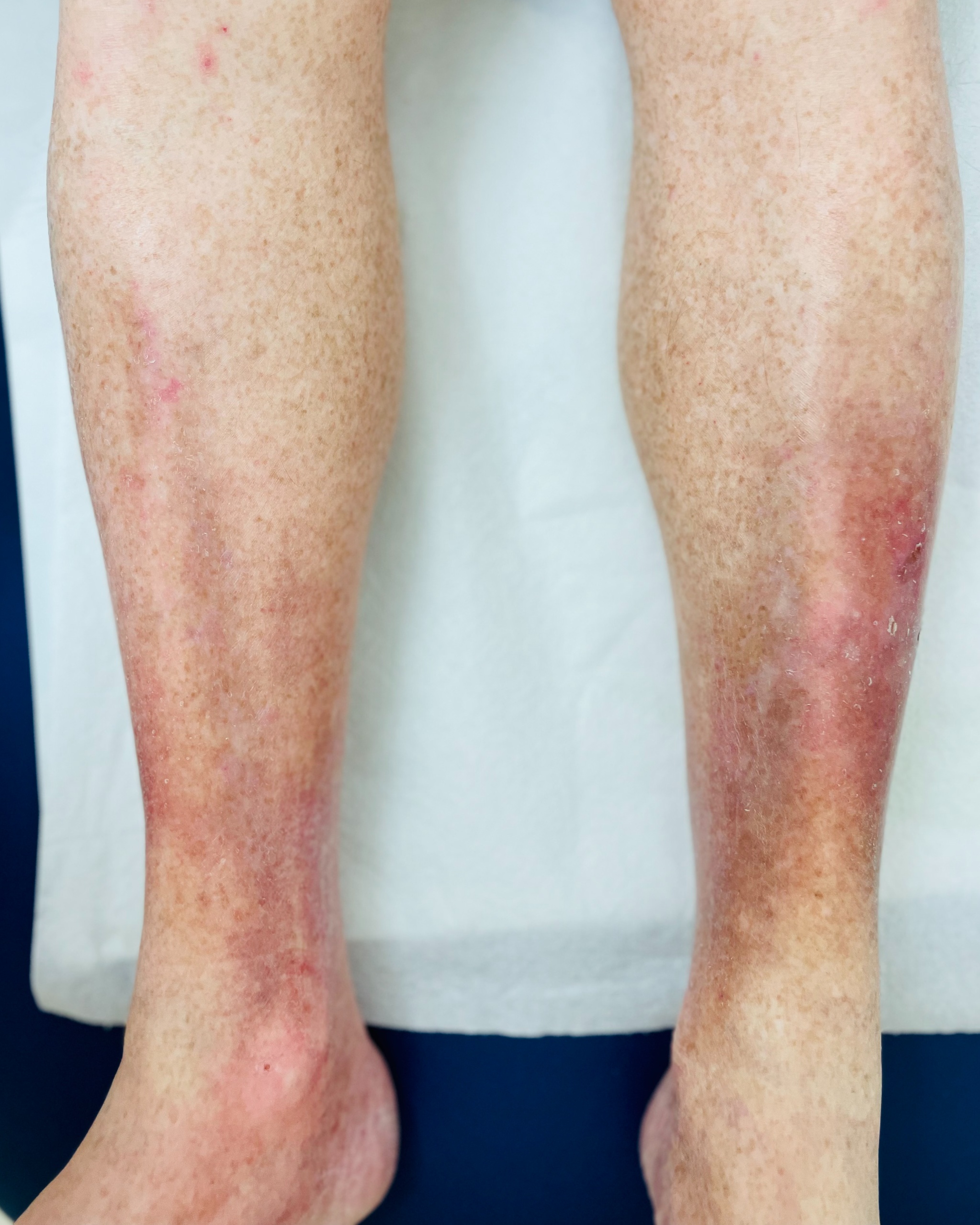 Stasis Dermatitis - Lower Legs