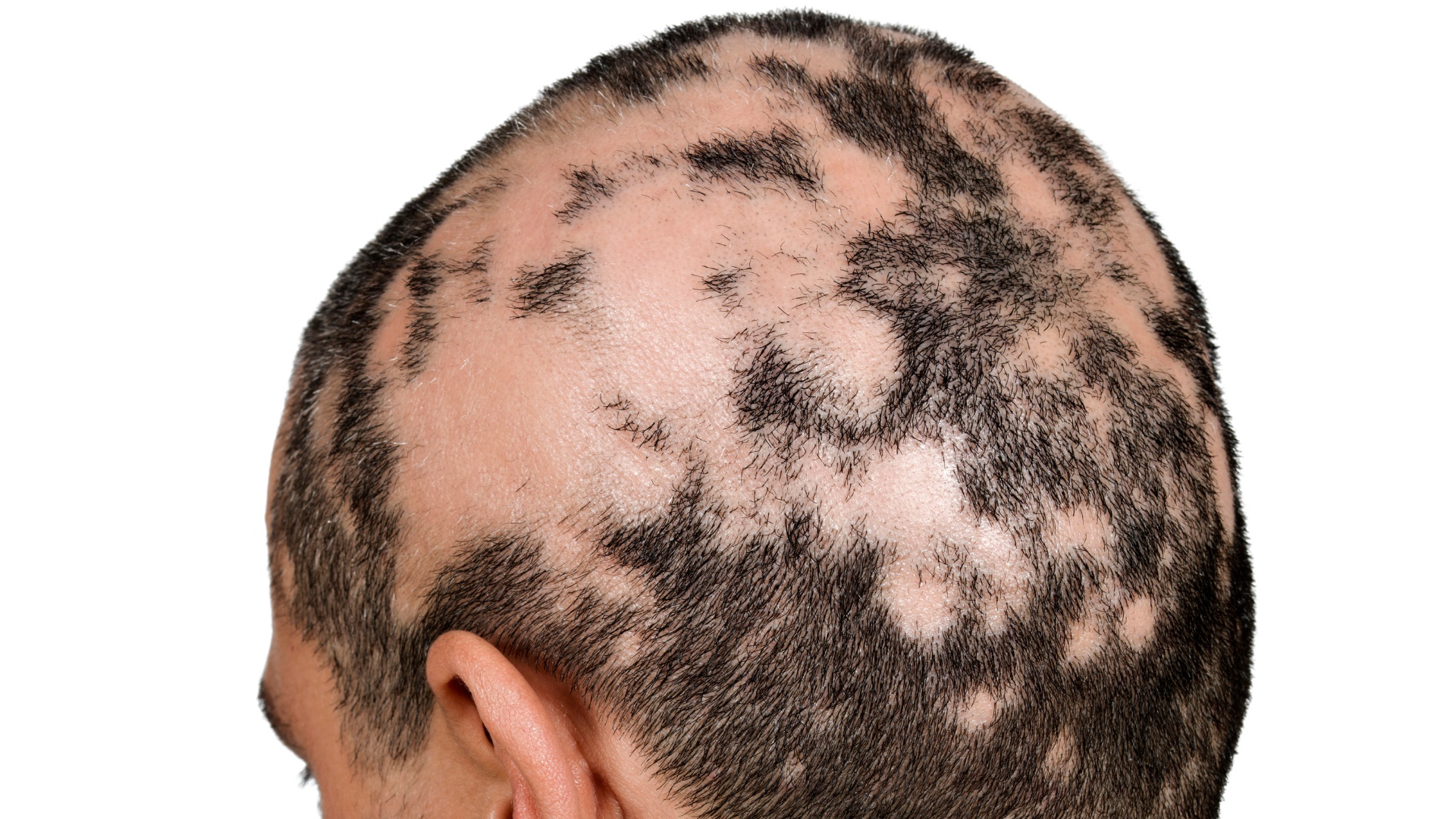 Alopecia Areata - Head