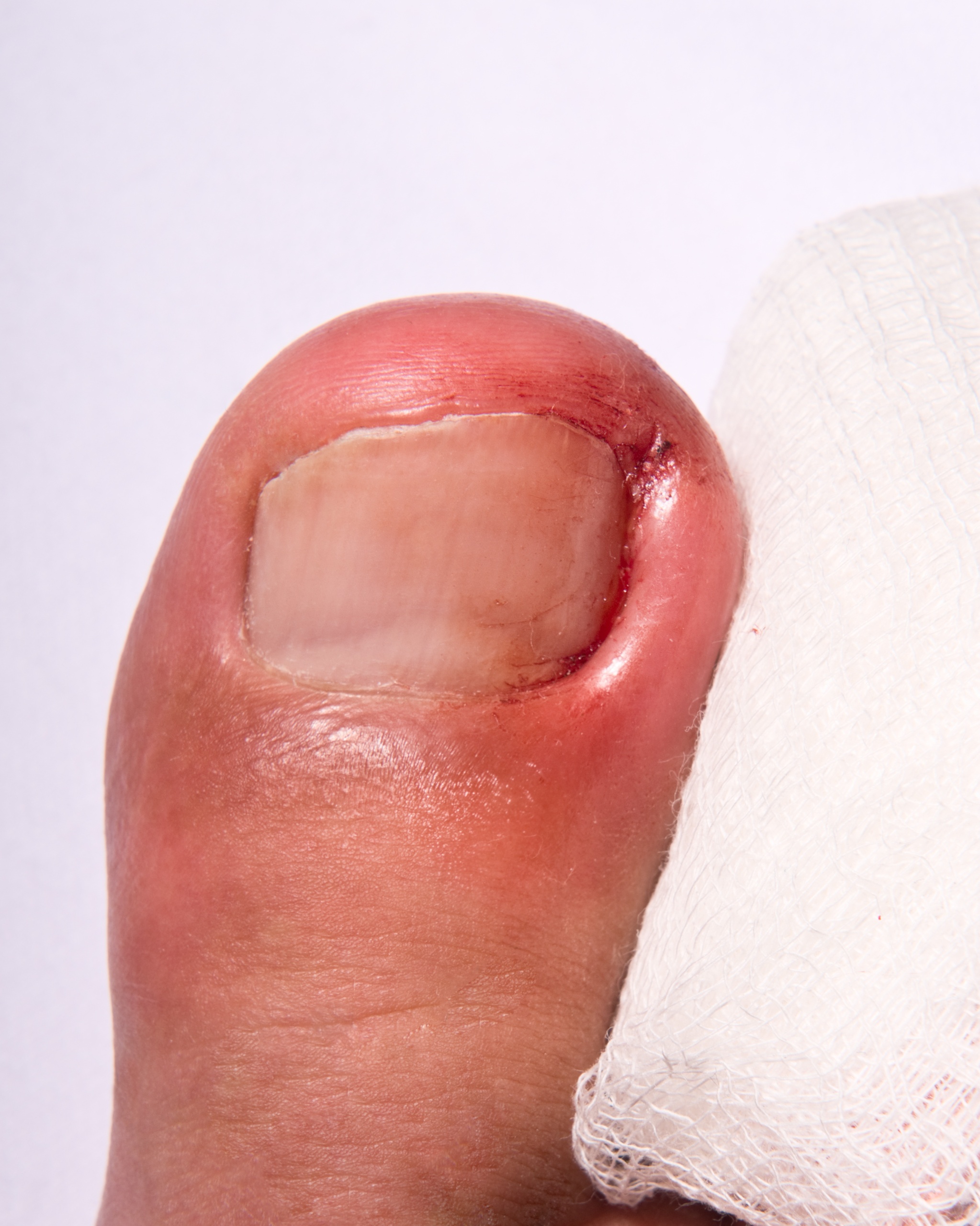 Ingrown Toenail (Onychocryptosis) - Toe
