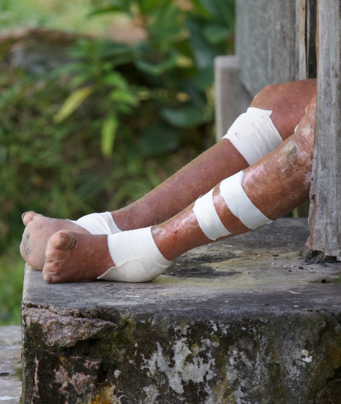 Leprosy (Hansen's Disease) - Legs