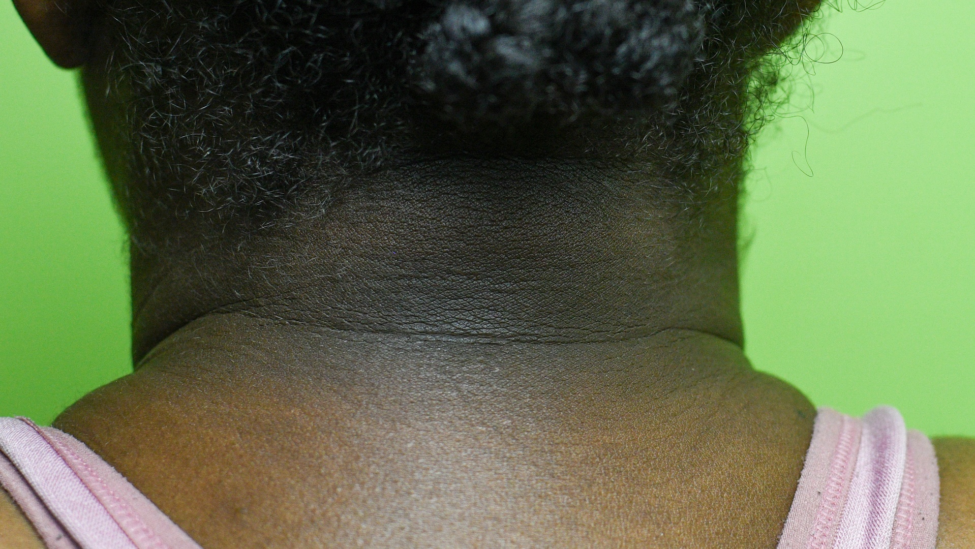 Acanthosis Nigricans - Neck