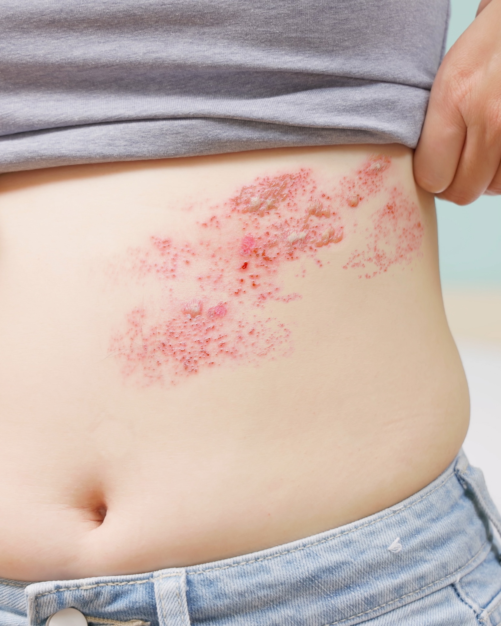 Herpes Zoster (Shingles) - Torso