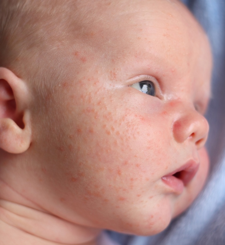 Infantile Acne - Face