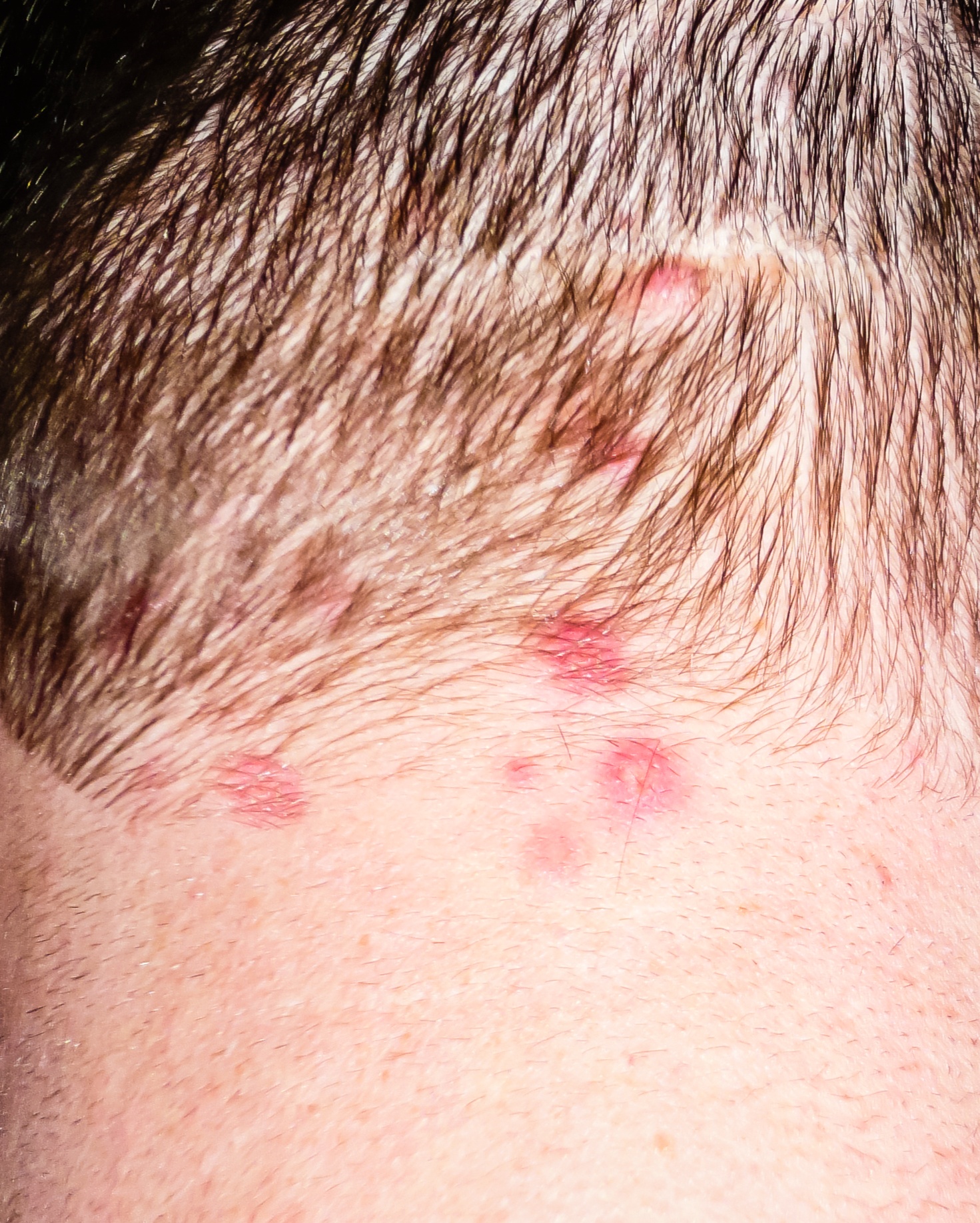 Dermatitis Herpetiformis - Neck